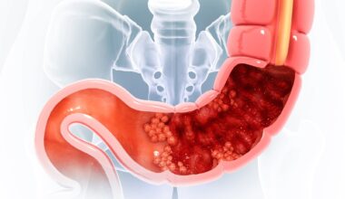 Study: Association of coffee intake with risk of all-cause and colorectal cancer-specific mortality among individuals with colorectal cancer in the Multiethnic Cohort Study. Image Credit: crystal light / Shutterstock