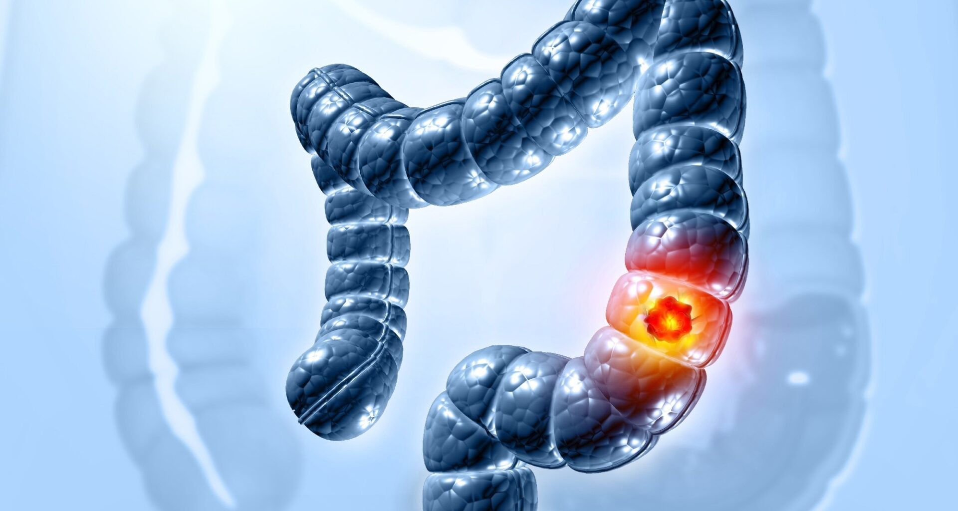 Why are more younger adults in the Eastern Mediterranean facing colorectal cancer?