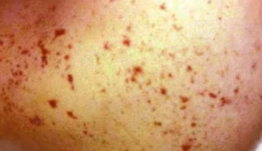 Second meningococcal alert in weeks sees child in hospital in WA