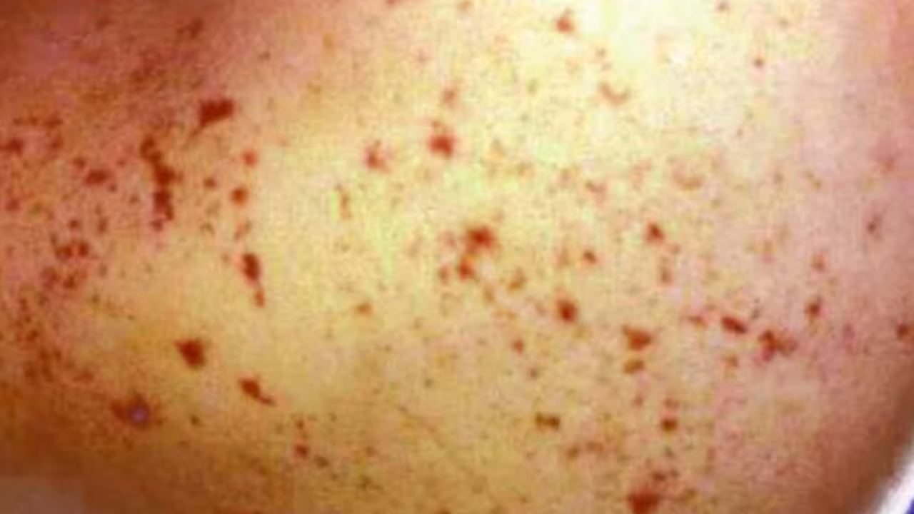 Second meningococcal alert in weeks sees child in hospital in WA