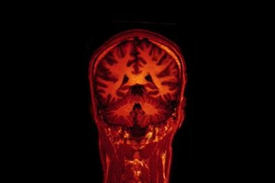 A magnetic resonance imaging (MRI) brain scan