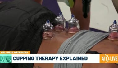 Cupping Therapy Explained