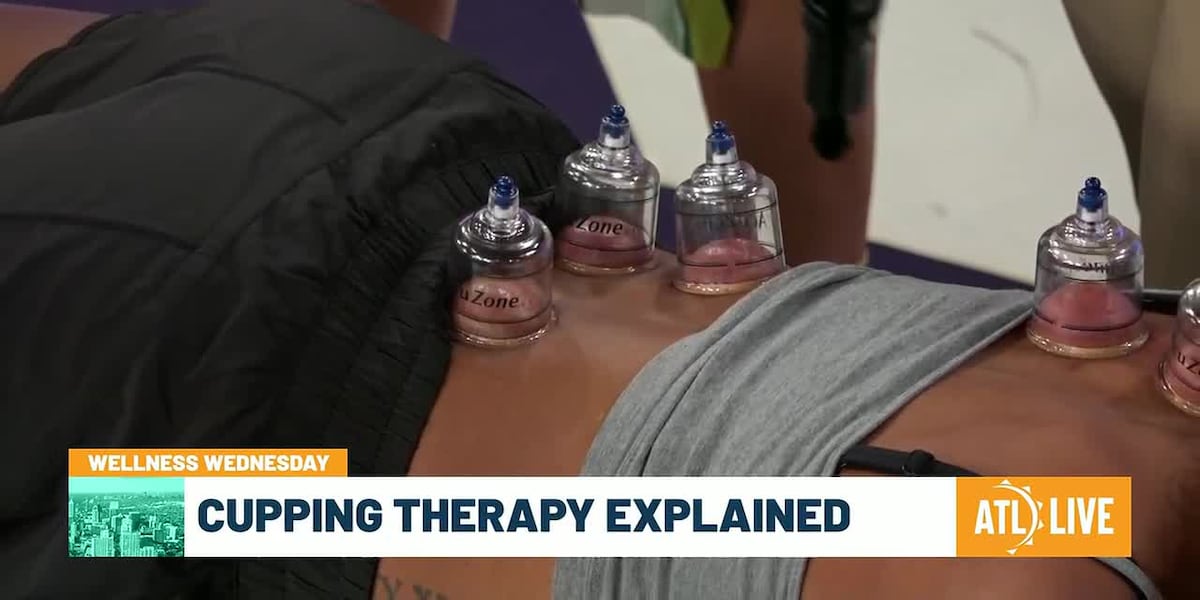Cupping Therapy Explained