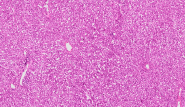 Childhood chemotherapy may increase future disease risk