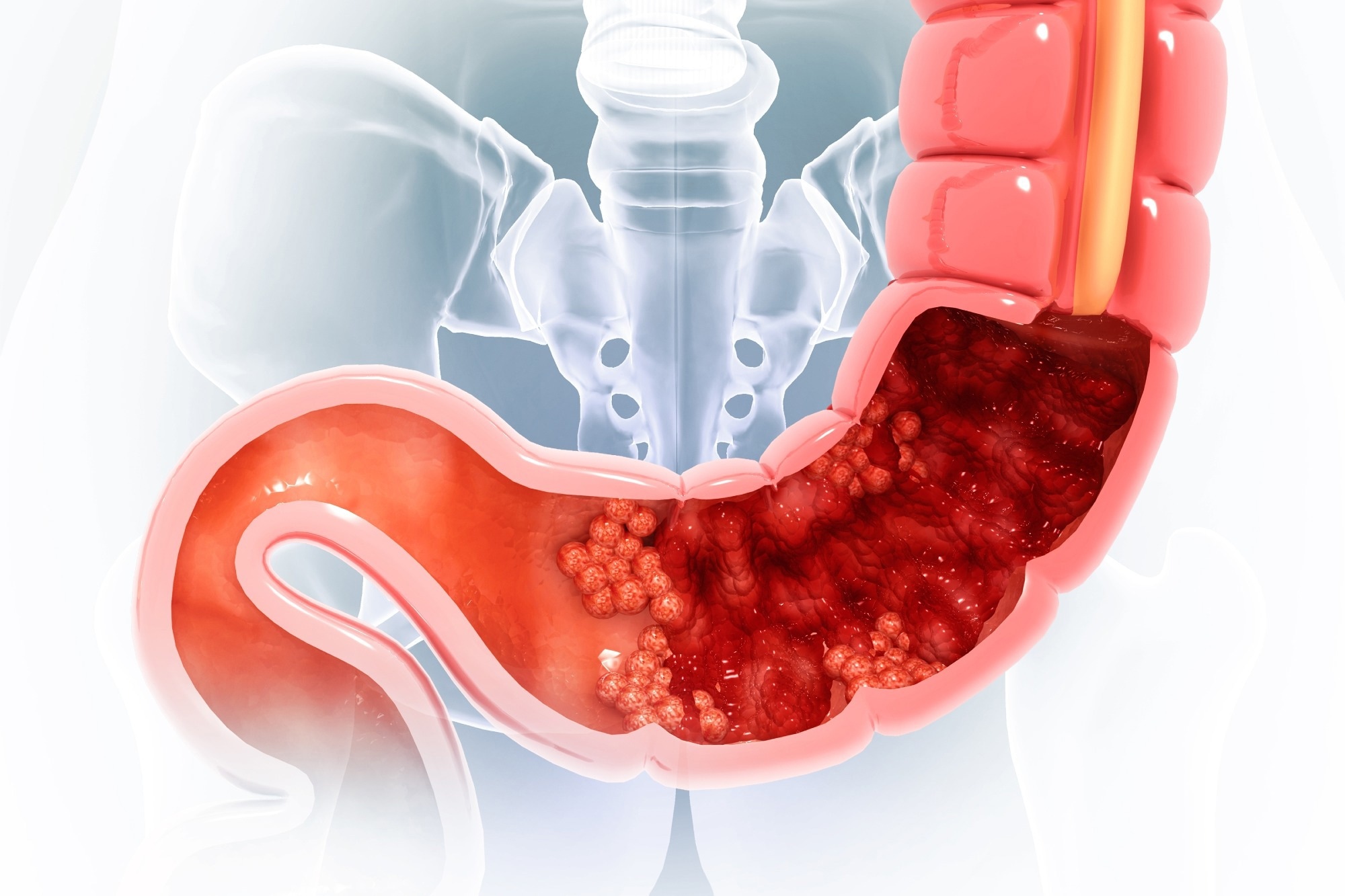 Study: Association of coffee intake with risk of all-cause and colorectal cancer-specific mortality among individuals with colorectal cancer in the Multiethnic Cohort Study. Image Credit: crystal light / Shutterstock
