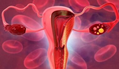 Immunotherapy shows potential for treating rising gynecological tumors