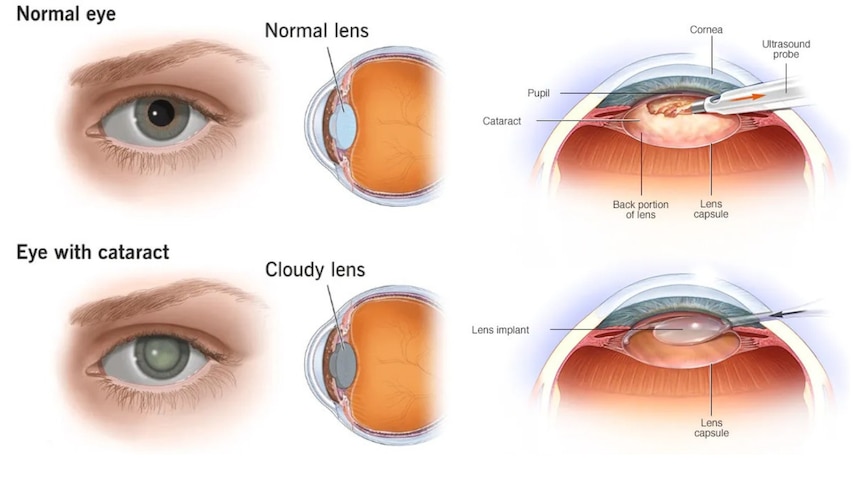 An illustration showing what eyes look like with and without cataracts, and what the surgery involves.