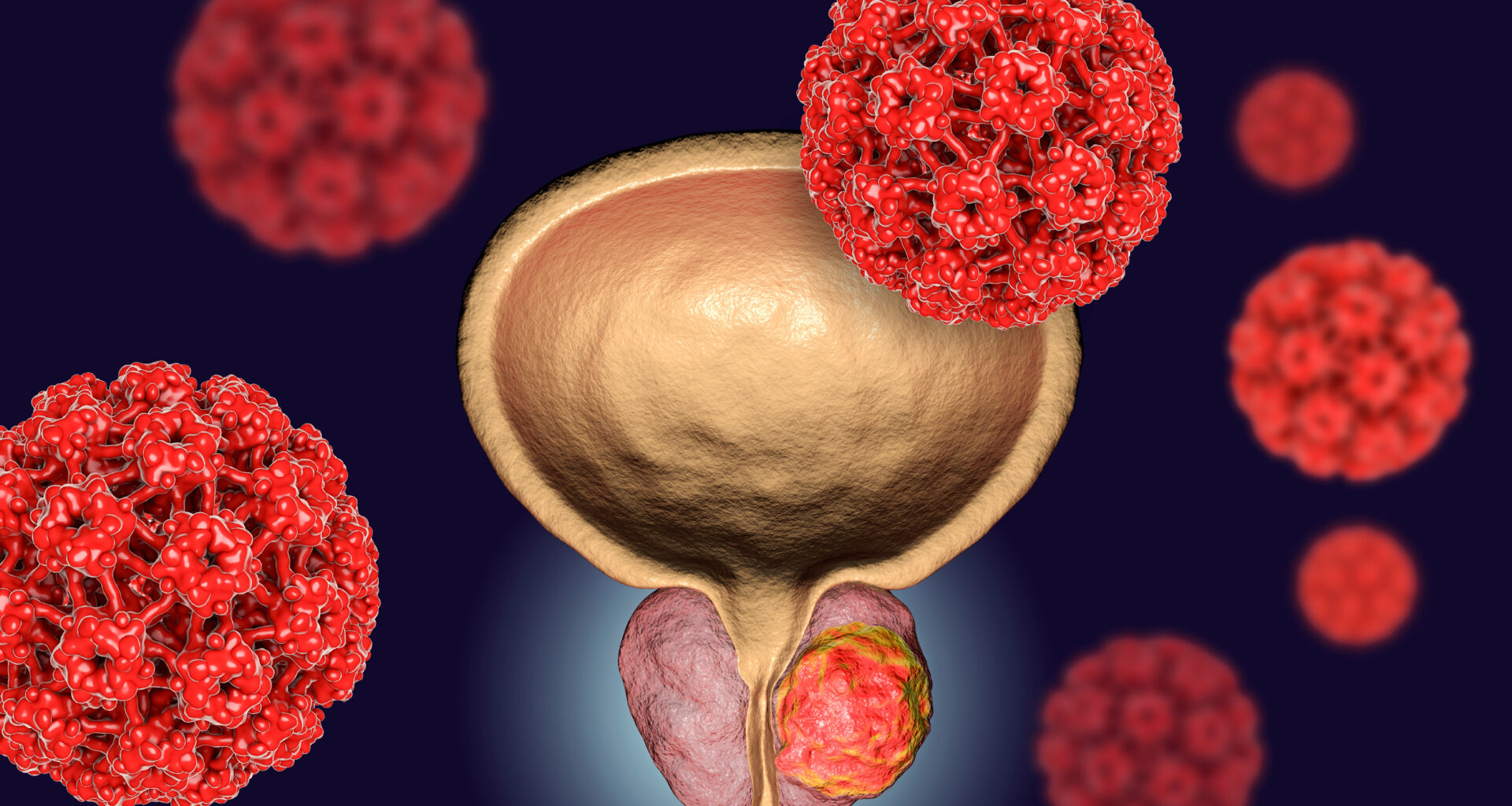 ASTRO Issues Its First Clinical Guideline on Radiation Therapy for Bladder Cancer