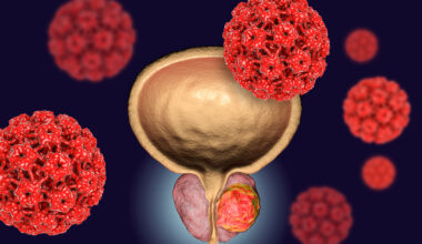 ASTRO Issues Its First Clinical Guideline on Radiation Therapy for Bladder Cancer