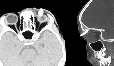 Teen is 'first' patient to have a tooth growing in bizarre place