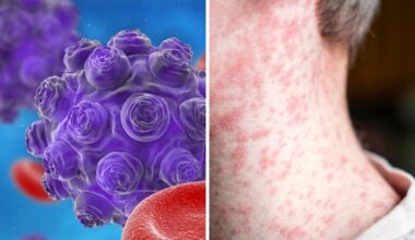 Dire warning as measles outbreak hits school