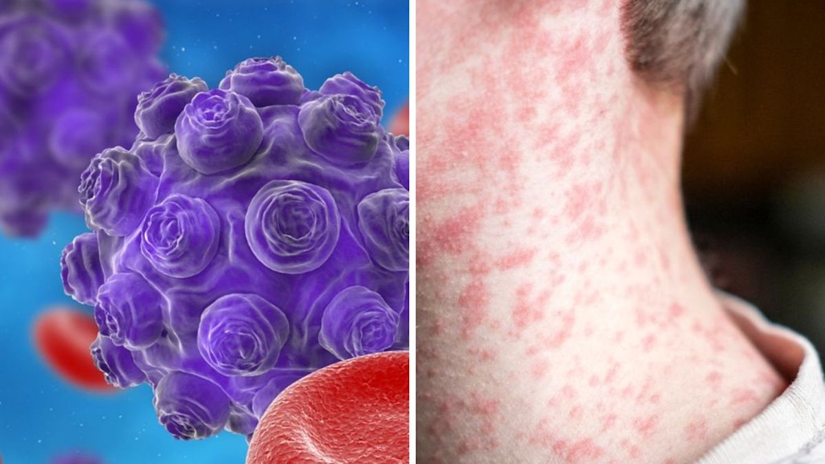 Dire warning as measles outbreak hits school