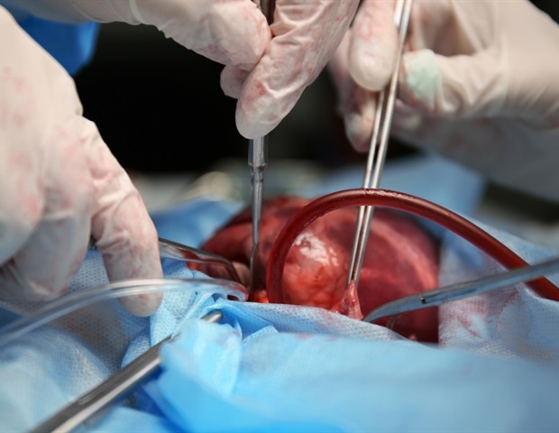 Muscle matters: Simple scan could predict heart surgery risks