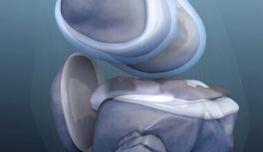 Robotic hip and knee replacement shows no early surgical benefit