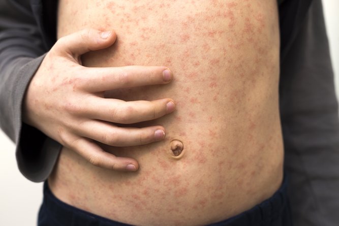 Symptoms include fever, fatigue, cough, runny nose and sore eyes, followed by a red, non-itchy rash. 