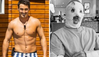 Love Island star Trent Woolman gives graphic bonfire horror update