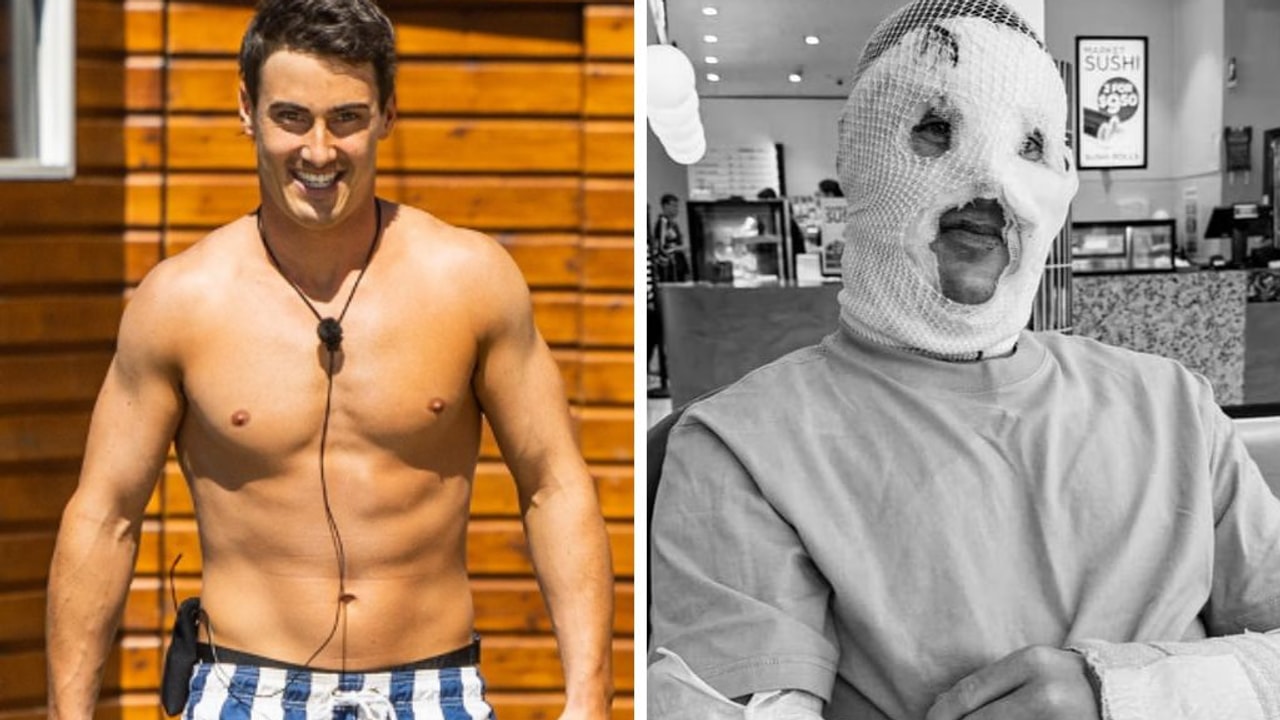 Love Island star Trent Woolman gives graphic bonfire horror update