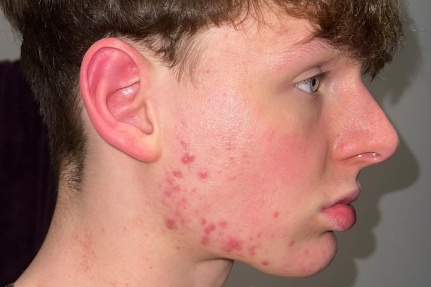Profile of a young man with a large nose and acne