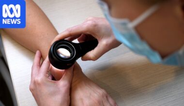 Melanoma vaccine trial results 'phenomenal', researcher says