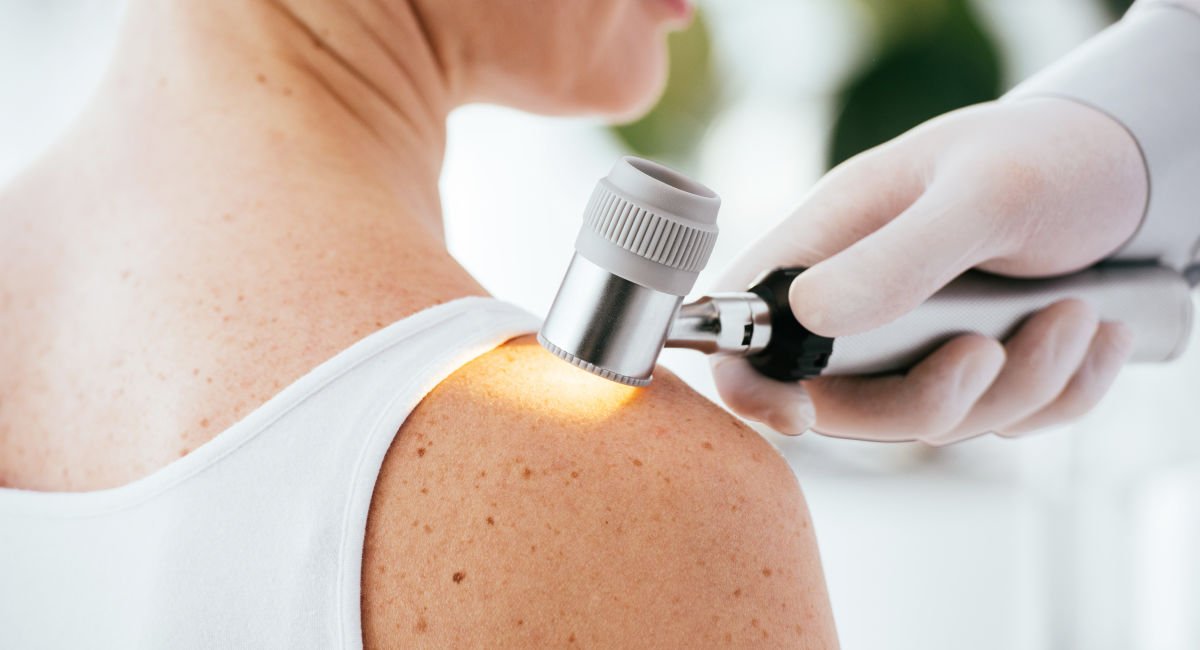 Study helps unravel melanoma mystery