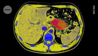 Can pancreatic cancer be stopped in its tracks? Radical tactic raises hopes