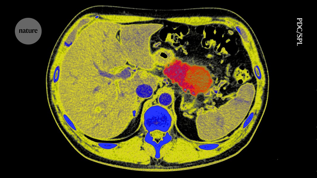 Can pancreatic cancer be stopped in its tracks? Radical tactic raises hopes