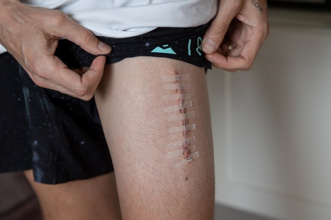 The scar on Mr Gore’s leg.