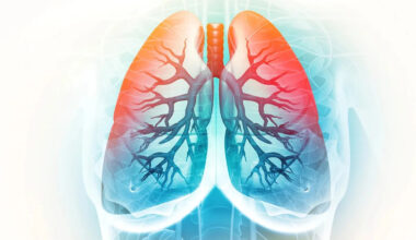 Bristol Myers dips on ‘confounding’ lung drug results