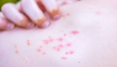 Scabies Outbreak Causes Hospital to Close Multiple Wards