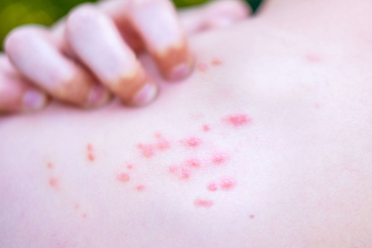Scabies Outbreak Causes Hospital to Close Multiple Wards