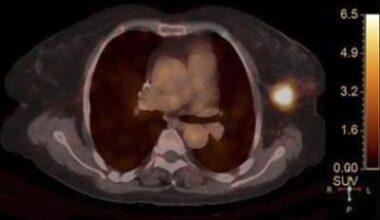 HER2-positive breast cancer: PET/CT technique shows promise for predicting treatment response • healthcare-in-europe.com