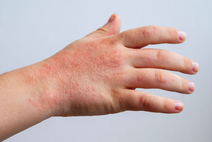A close-up of a hand with a red, irritated skin rash, showing health problems in Gen Z.