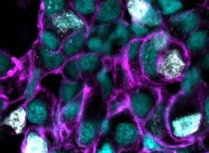 Research reveals genetic weak spot in hard-to-treat cancers