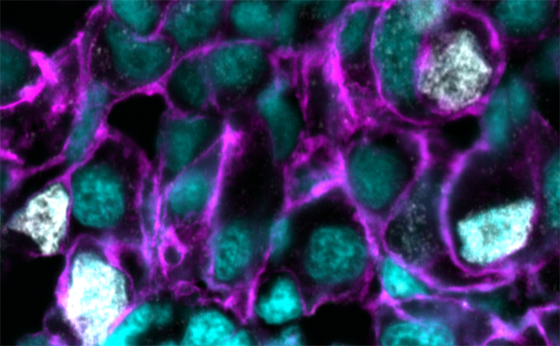 Research reveals genetic weak spot in hard-to-treat cancers