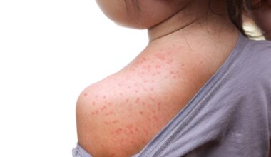Measles exposure reported from recent Chi-Cheemaun ferry trips