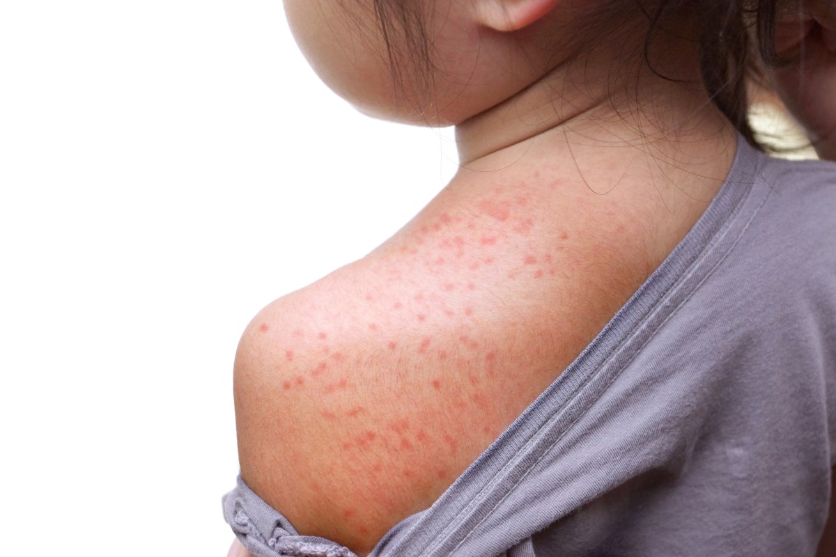 Measles exposure reported from recent Chi-Cheemaun ferry trips