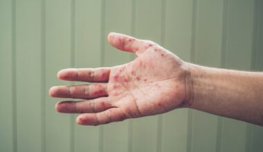 Alberta adds 31 measles cases to pass 1,400 total