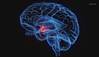 Why some antidepressant medication can cause more sweating: HealthLink