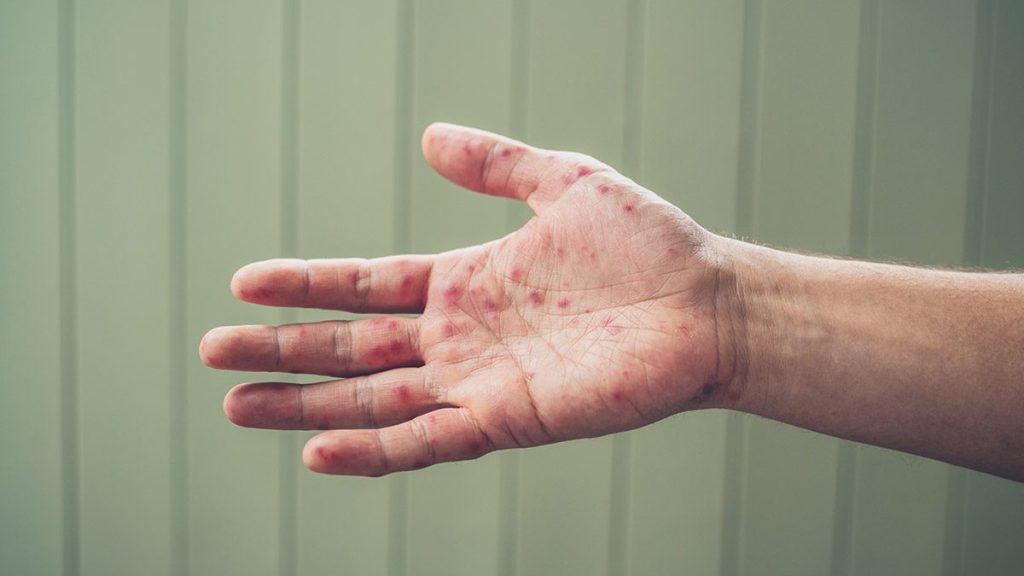 Potential measles exposure at four locations in York Region over the past week