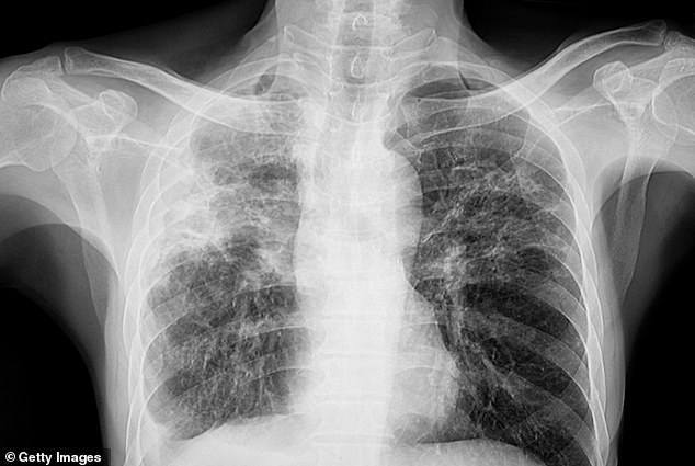 The names and ages of the patients have not been revealed. The above shows a chest X-ray of a person with tuberculosis
