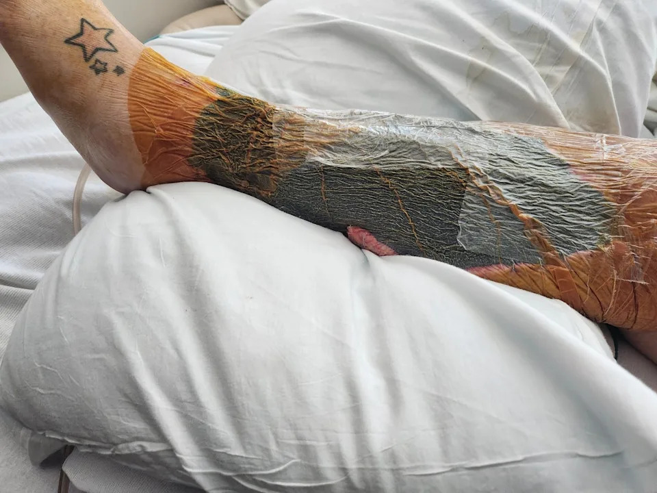 She underwent muscle graft surgery (GoFundMe)