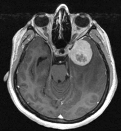 New Genetic Biomarker Flags Aggressive Brain Tumors