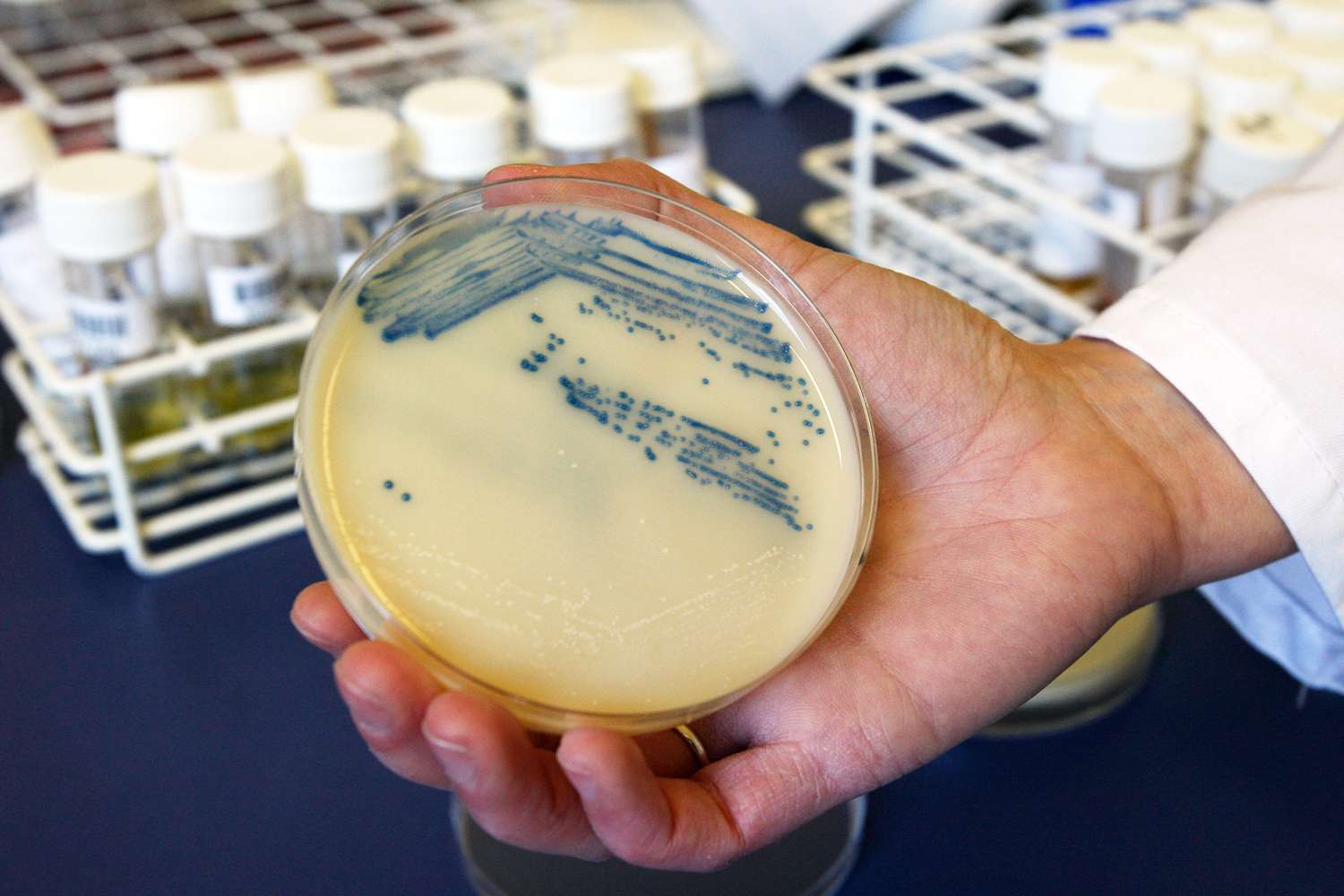 Deadly Drug-Resistant Fungus Is Sweeping Through Hospitals