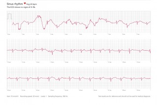 Watch GT 6  Pro sample ECG reading
