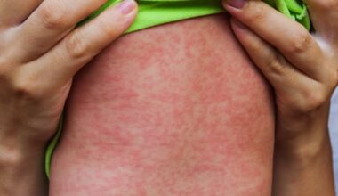 Sask. measles case sends patient to intensive care