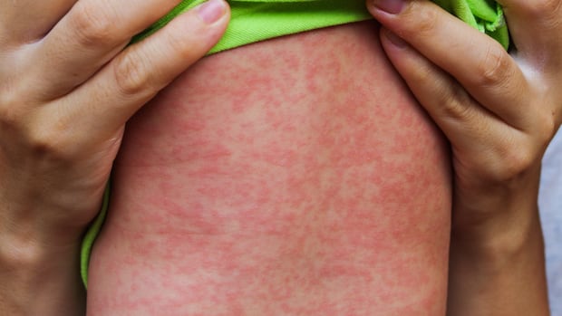Sask. measles case sends patient to intensive care