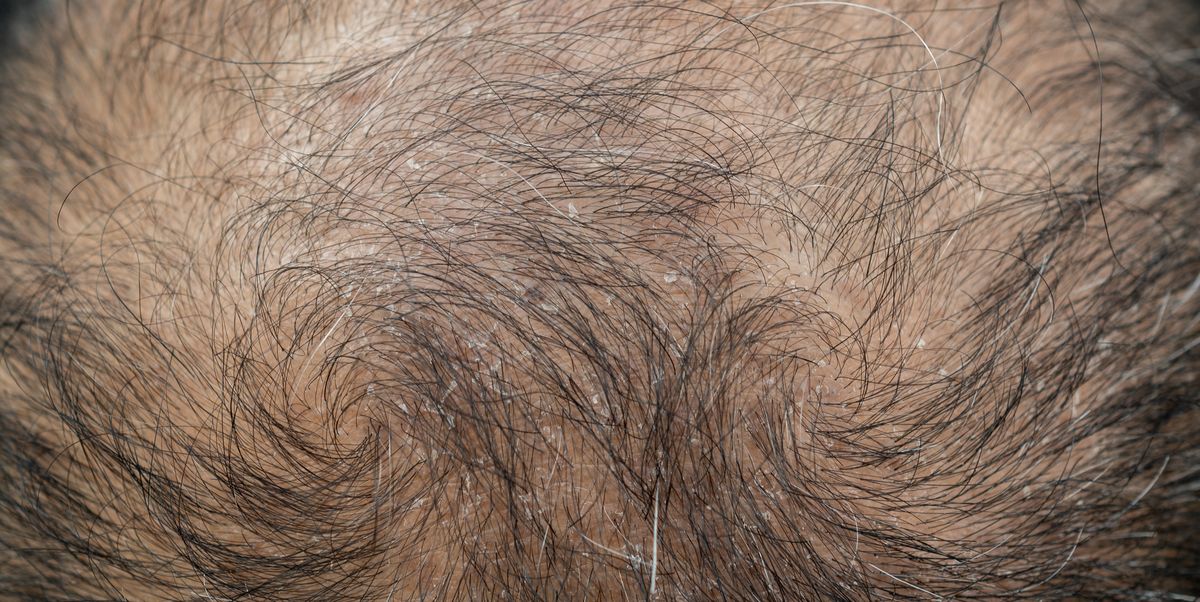 Scientists Found This Natural Sweetener Could Help Regrow Your Hair