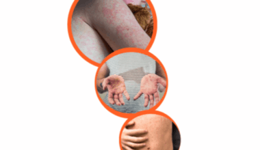 Manitoba Health flags new measles exposure sites: Measles Update #40 - DiscoverWestman.com