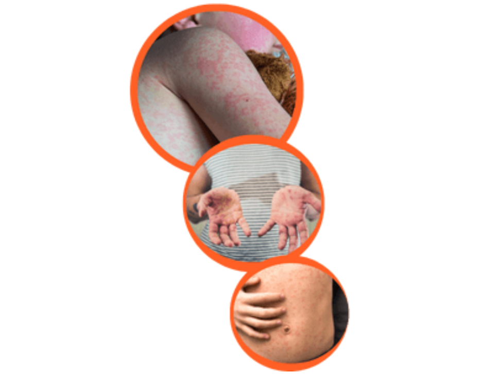 Manitoba Health flags new measles exposure sites: Measles Update #40 - DiscoverWestman.com