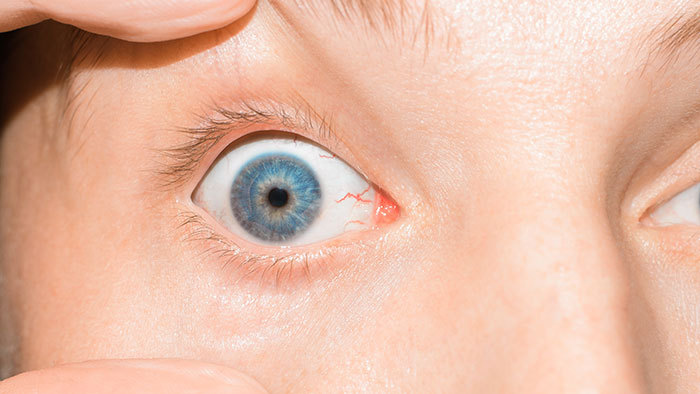 Close-up of a blue eye with visible red veins, illustrating common mistakes in self-diagnosed medical conditions.